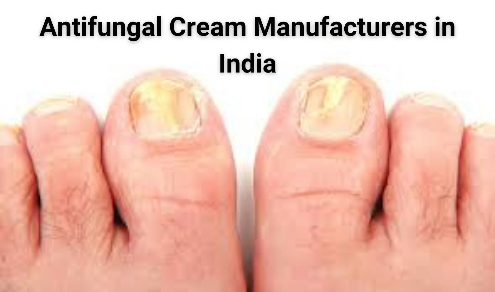 OLOEY Toenail Fungus Treatment Cream,Nail Fungus India | Ubuy